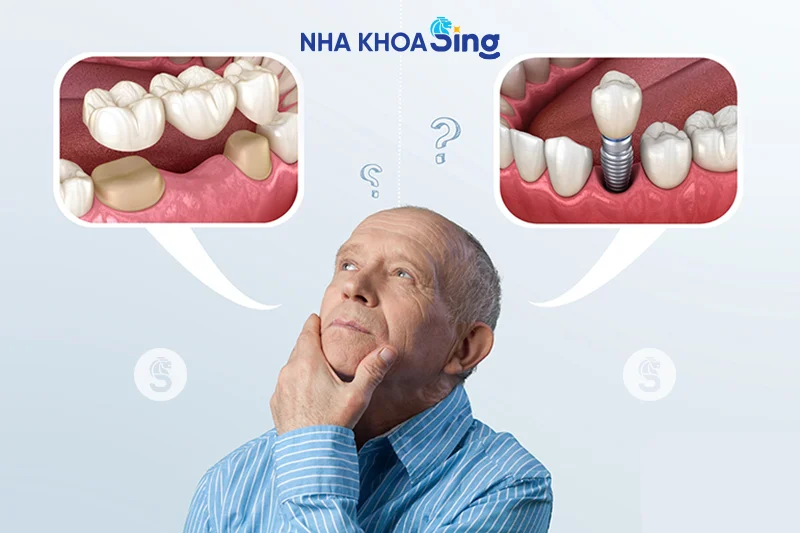 cau-rang-su-va-implant-3