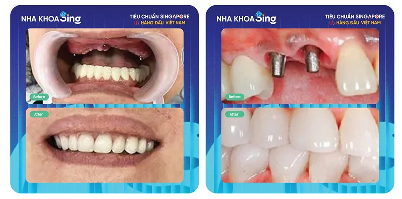 cau-tao-rang-implant-2