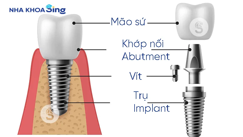 cau-tao-tru-implant