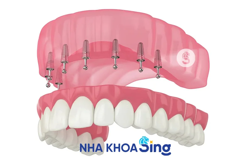 cay-ghep-mini-implant-1-1