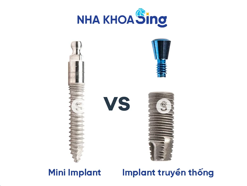 cay-ghep-mini-implant-1