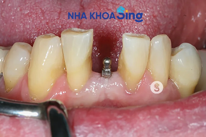 cay-ghep-mini-implant-2