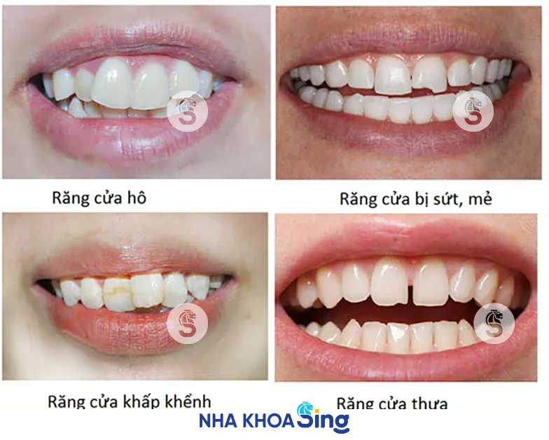 dan-su-veneer-2-rang-cua-gia-bao-nhieu-1
