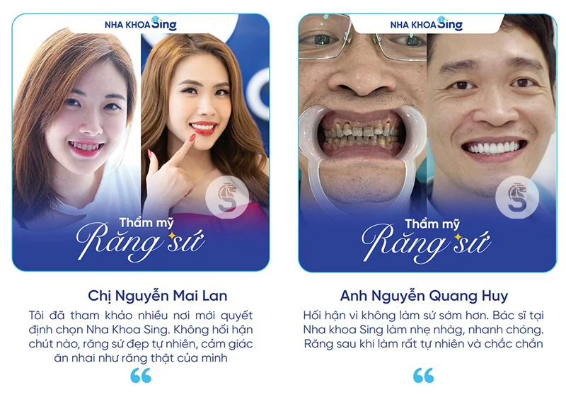 dan-su-veneer-2-rang-cua-gia-bao-nhieu-2
