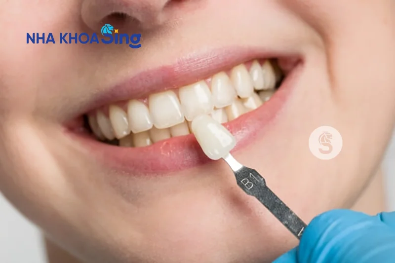dan-su-veneer-2-rang-cua-gia-bao-nhieu