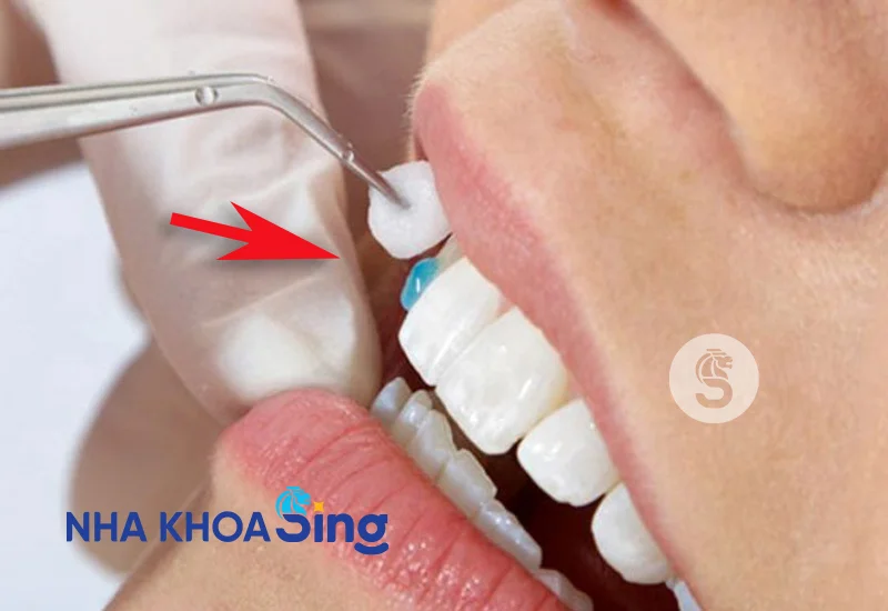 dan-su-veneer-co-ben-khong-1