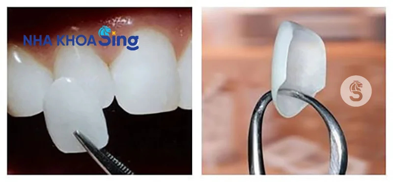 dan-su-veneer-co-ben-khong-2
