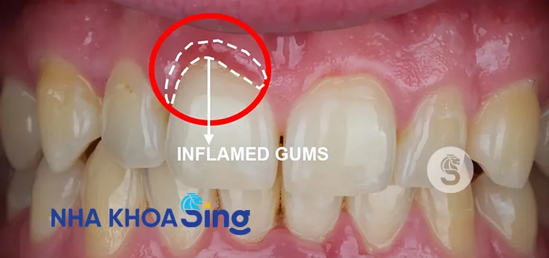 dan-su-veneer-co-bi-hoi-mieng-khong-1