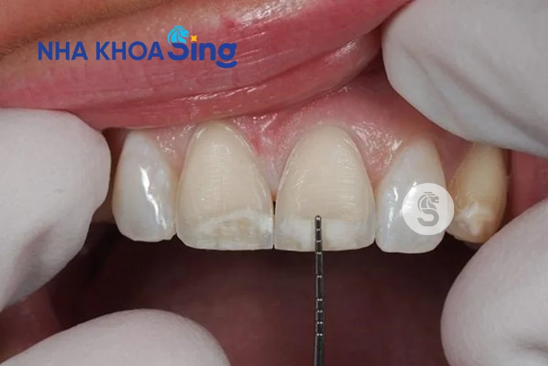 dan-su-veneer-co-tot-khong-1
