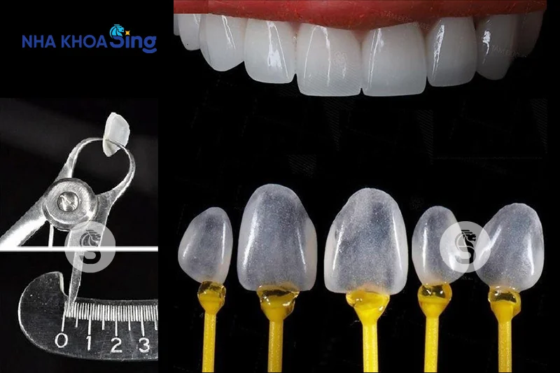 dan-su-veneer-gia-bao-nhieu-1