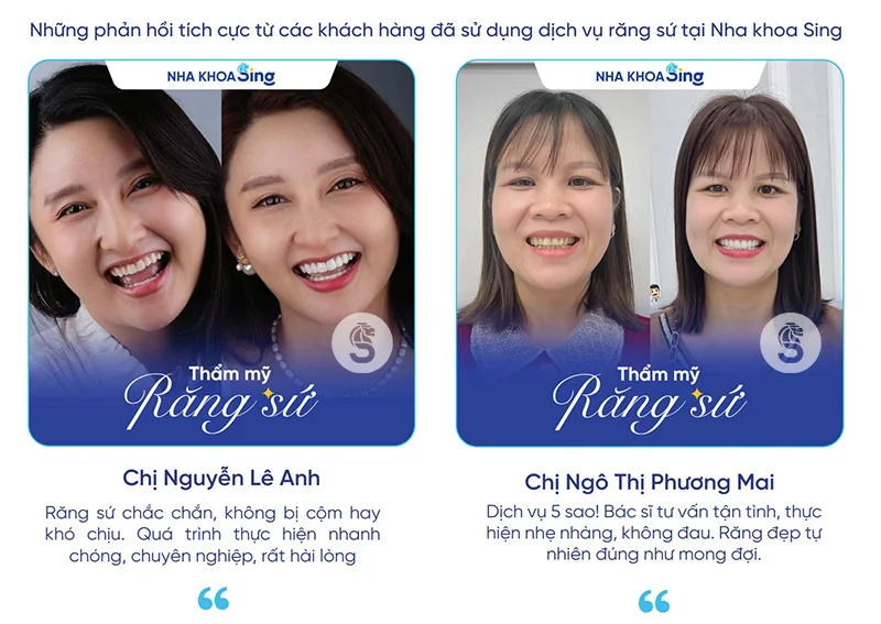 dan-su-veneer-gia-bao-nhieu-3