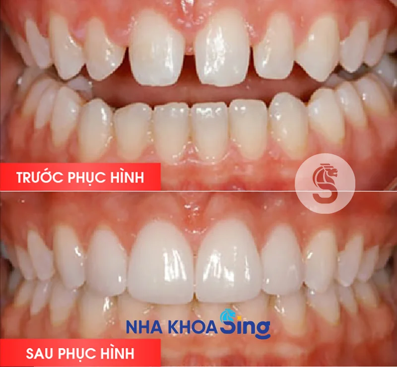 dan-su-veneer-rang-thua
