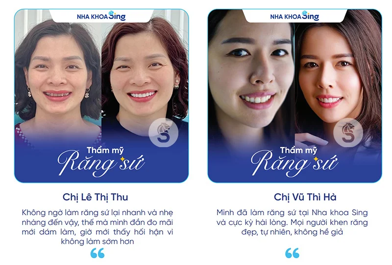 dang-mang-thai-co-nen-thuc-hien-dan-su-veneer-2