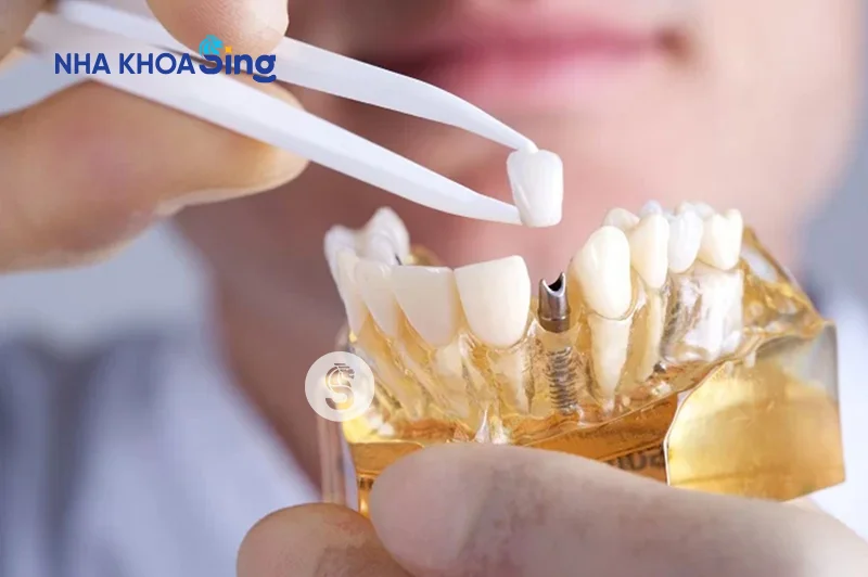 gia-trong-rang-implant-2
