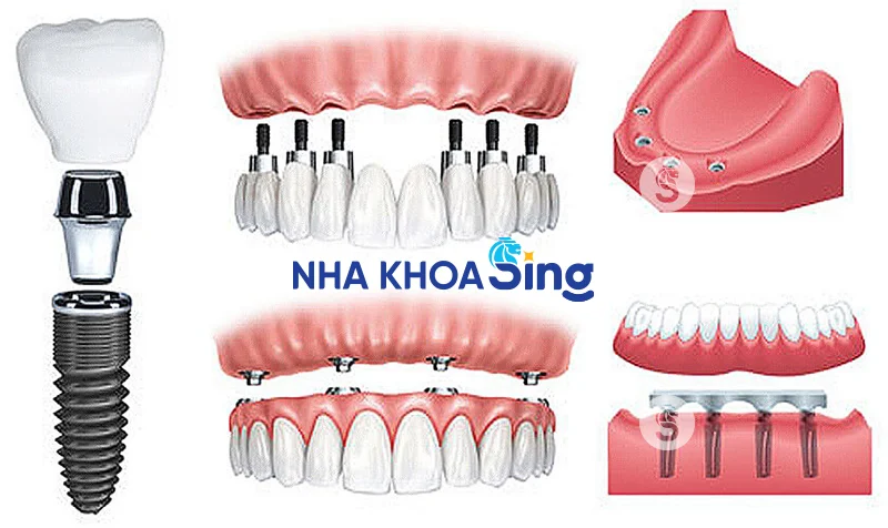 gia-trong-rang-implant-3