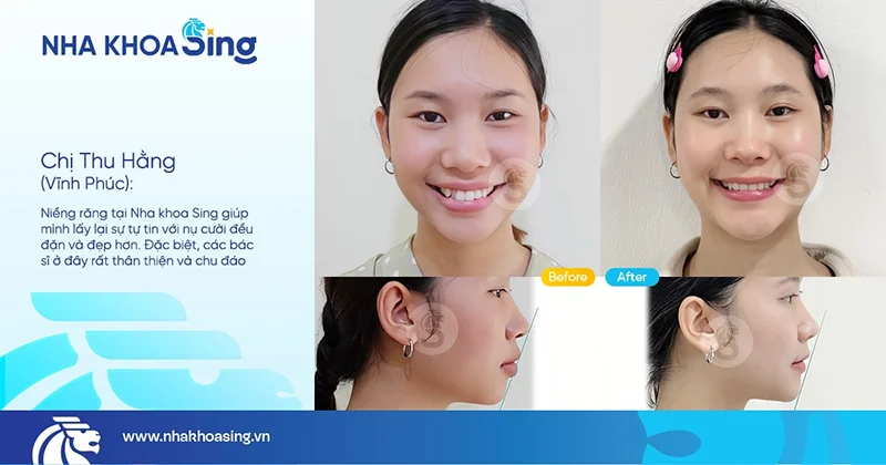 hinh-anh-khach-nieng-rang-tai-nha-khoa-sing-1
