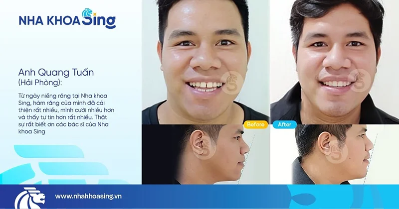 hinh-anh-khach-nieng-rang-tai-nha-khoa-sing-2
