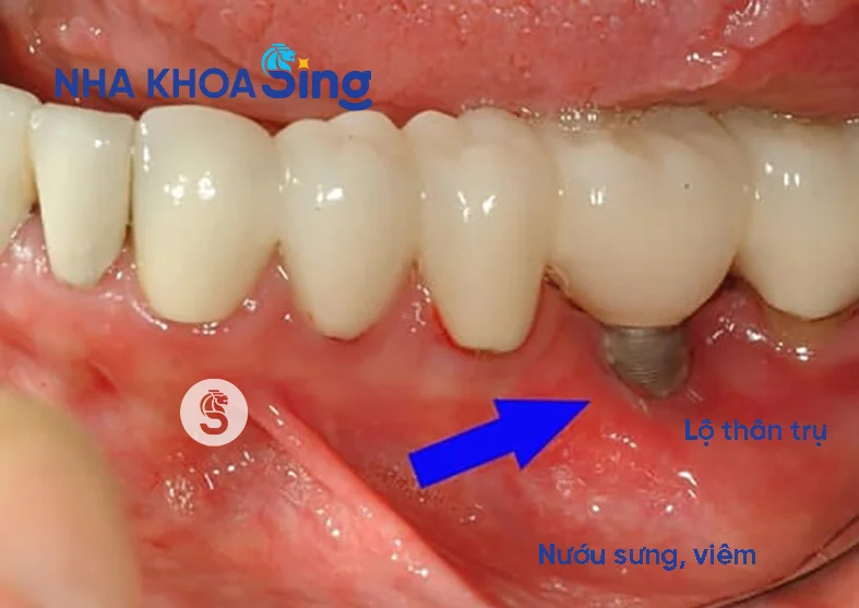 implant-bi-dao-thai-1