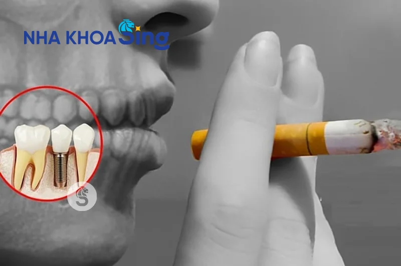 implant-bi-dao-thai-2