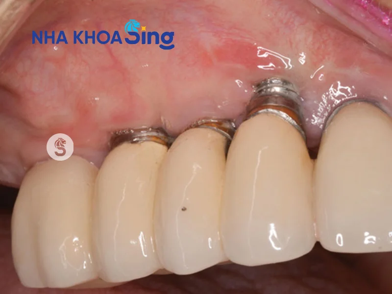 implant-bi-dao-thai