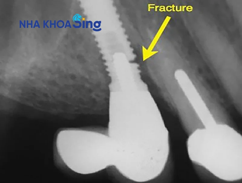 implant-bi-lung-lay-1