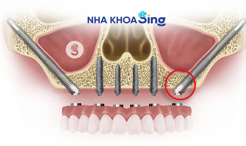 implant-xuong-go-ma-1