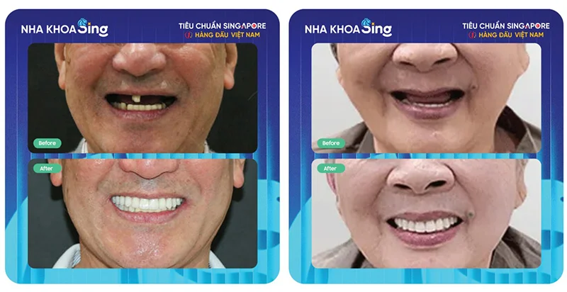 khi-nao-thi-trong-rang-implant-2
