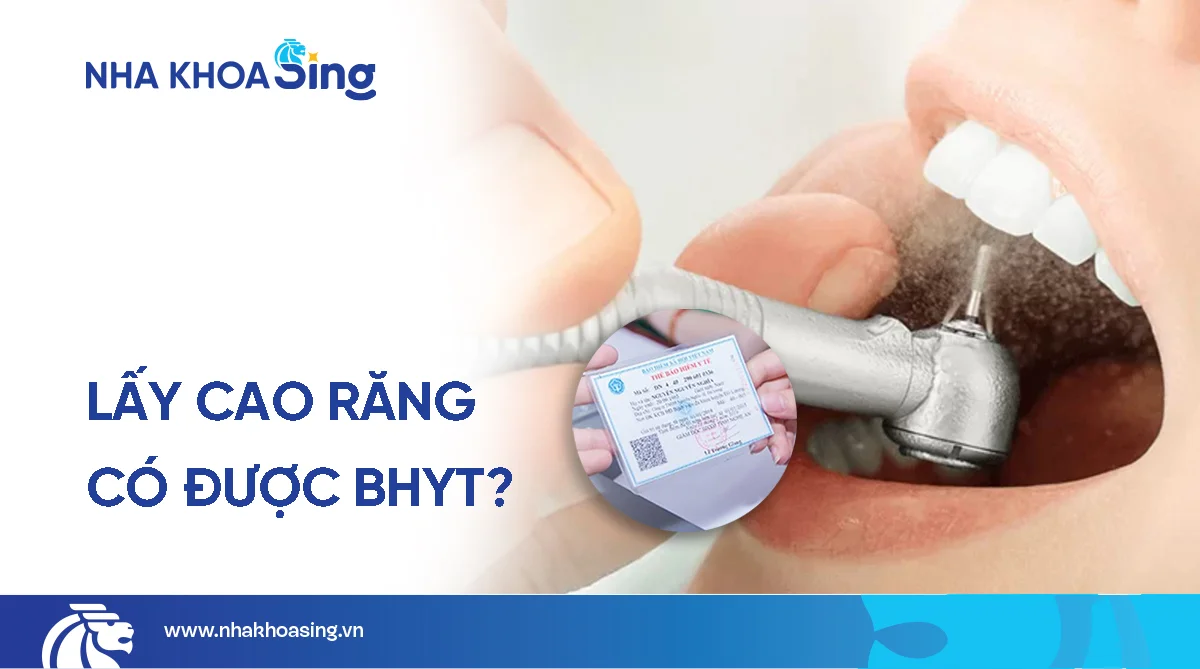 Lấy cao răng có được bảo hiểm y tế không? Giải đáp chi tiết