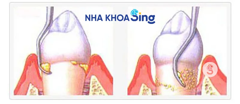 lay-cao-rang-co-lam-trang-rang-khong-2