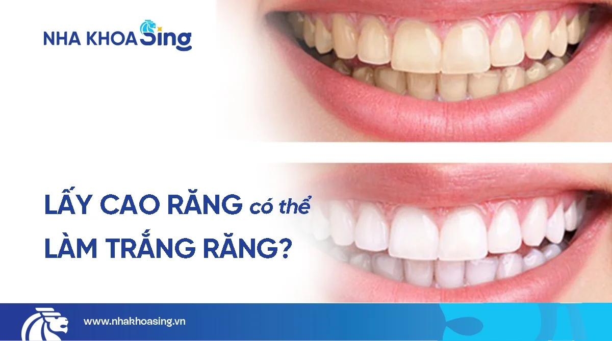 Lấy cao răng có làm trắng răng không? [Bác sĩ giải đáp]