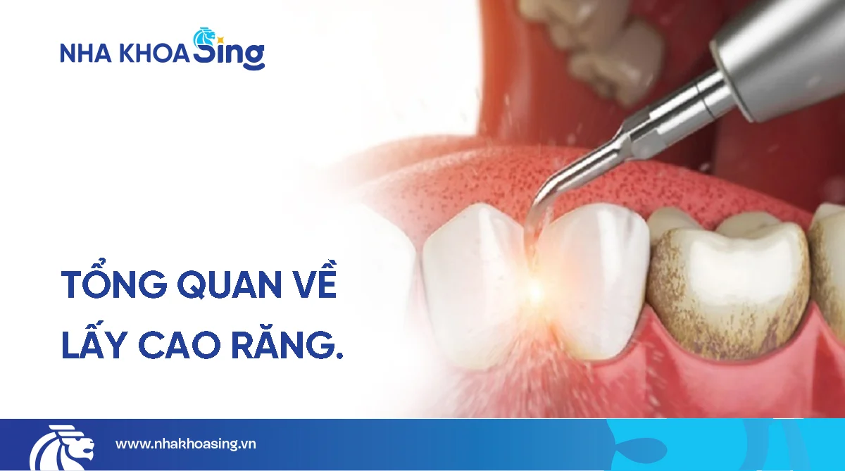Lấy cao răng: Quy trình, chi phí và những lưu ý quan trọng