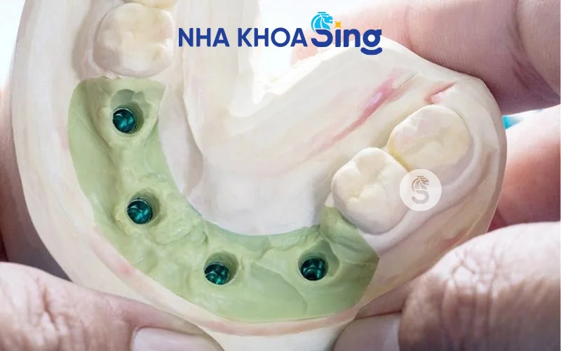 lay-dau-implant-1
