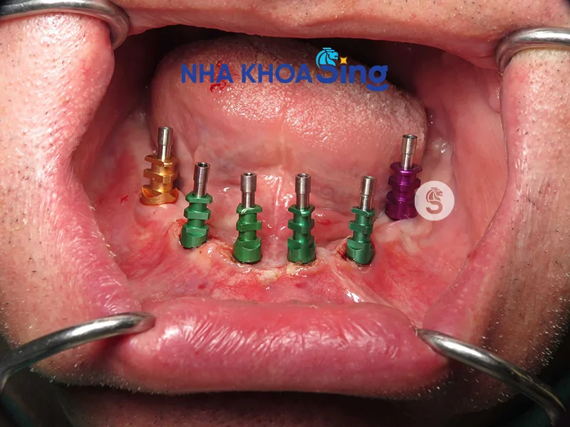 lay-dau-implant-3