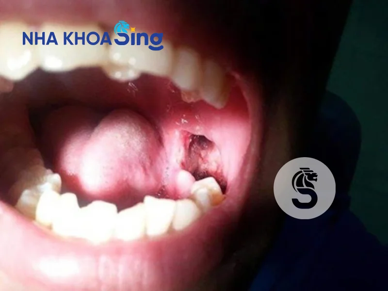 lo-sau-khi-nho-rang-khon