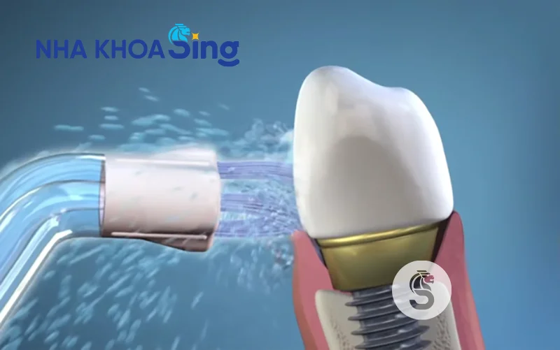 luu-y-khi-trong-rang-implant-3
