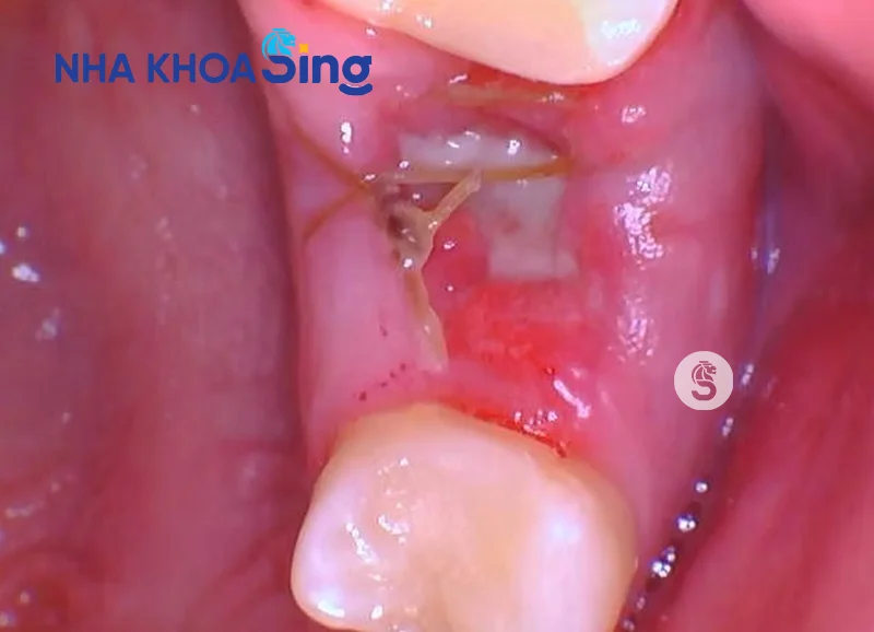 mang-trang-sau-khi-nho-rang-1