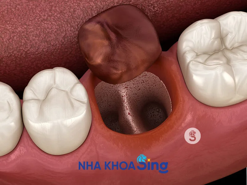 mang-trang-sau-khi-nho-rang-2