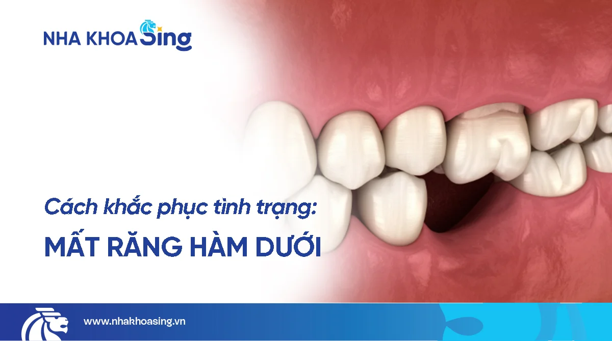 Mất răng hàm dưới: Nguyên nhân, ảnh hưởng & cách trồng răng hiệu quả