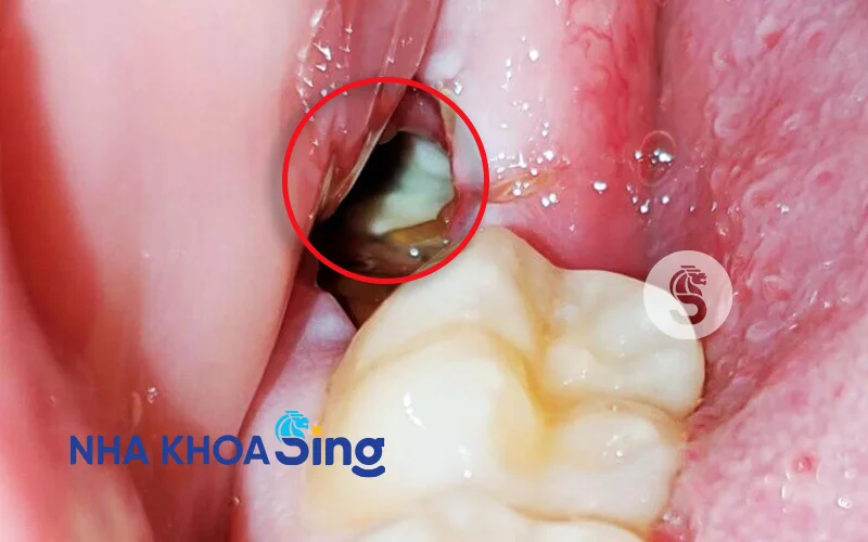 nhiem-trung-sau-khi-nho-rang-khon-2
