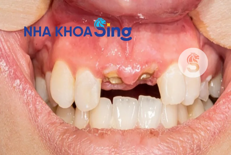 nho-rang-cua-1