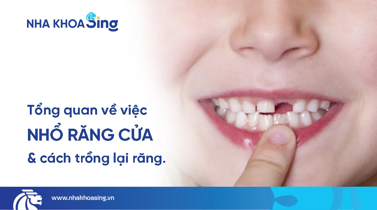 Nhổ răng cửa có đau không? Giá bao nhiêu? Khi nào nên nhổ?