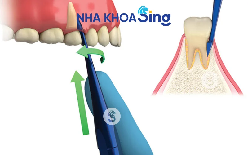 nho-rang-khon-bang-may-sieu-am-piezotome-2