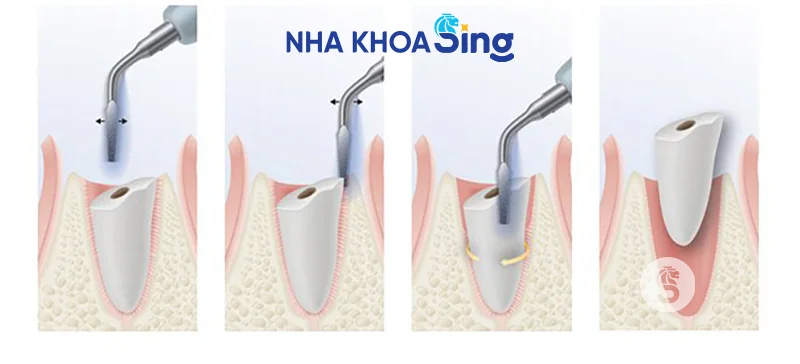 nho-rang-khon-bao-nhieu-tien-1