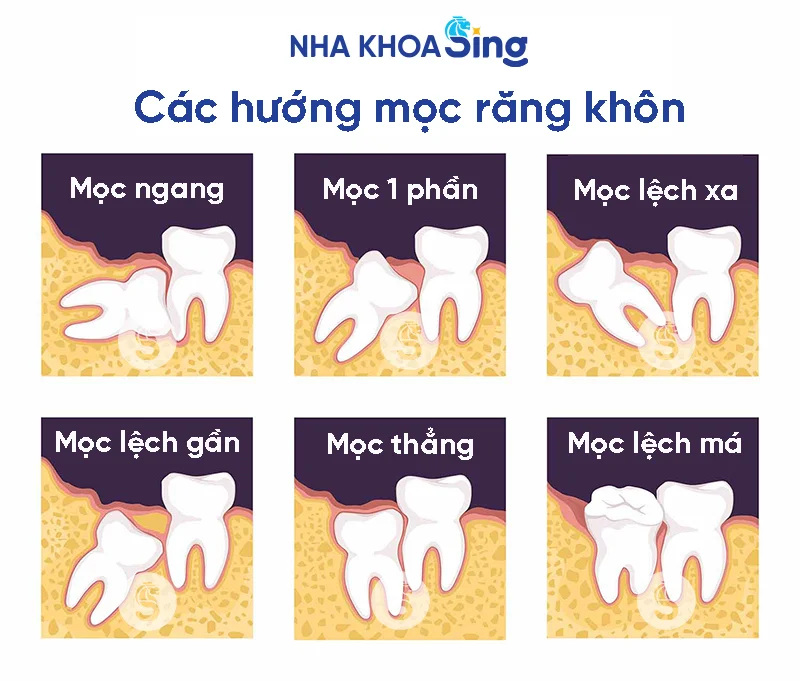 nho-rang-khon-bao-nhieu-tien