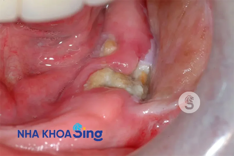 nho-rang-khon-bi-hoi-mieng-1