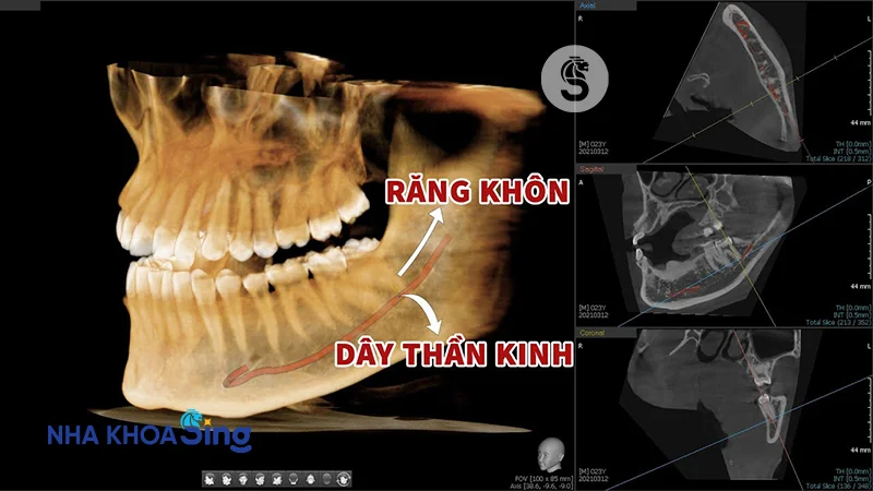 nho-rang-khon-co-anh-huong-den-than-kinh-khong-1