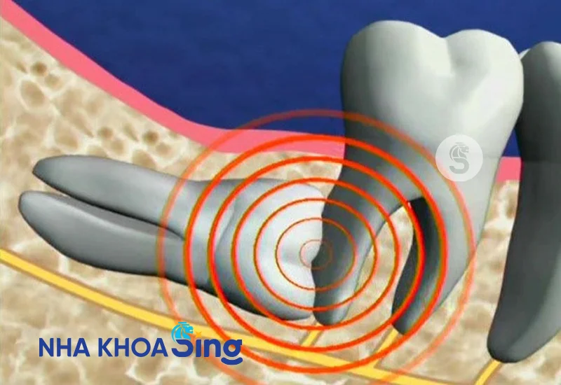nho-rang-khon-co-anh-huong-den-than-kinh-khong