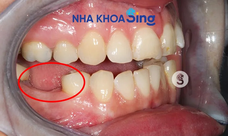 nho-rang-so-6-1-1