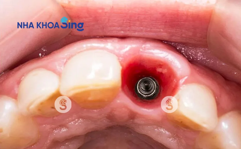 quy-trinh-trong-rang-implant-1