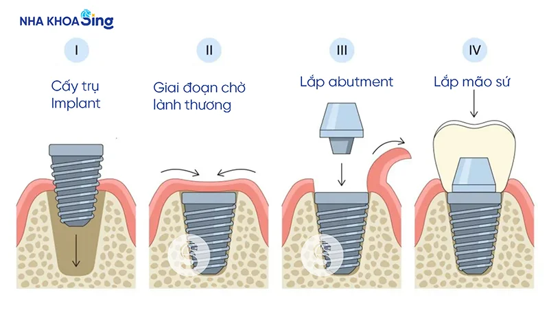 quy-trinh-trong-rang-implant